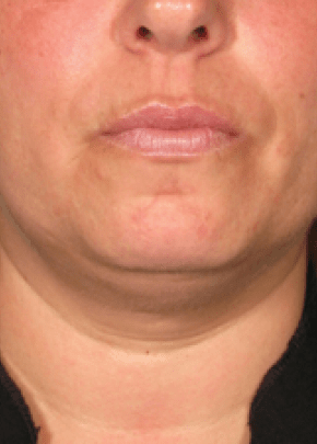 Ultherapy Before & After Patient #2190