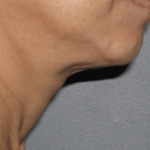 Ultherapy Before & After Patient #2189