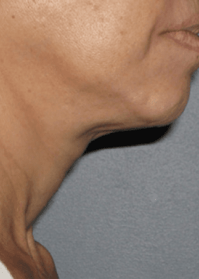 Ultherapy Before & After Patient #2189