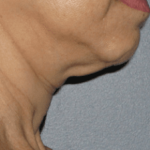 Ultherapy Before & After Patient #2189