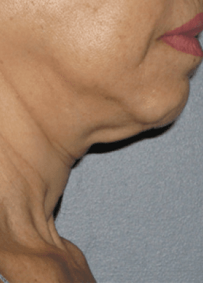 Ultherapy Before & After Patient #2189