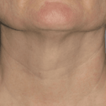 Ultherapy Before & After Patient #2188