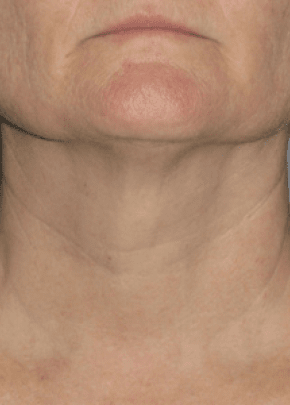 Ultherapy Before & After Patient #2188