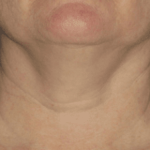 Ultherapy Before & After Patient #2188