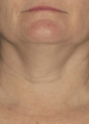 Ultherapy Before & After Patient #2188