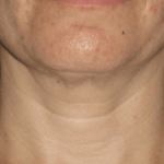Ultherapy Before & After Patient #2187