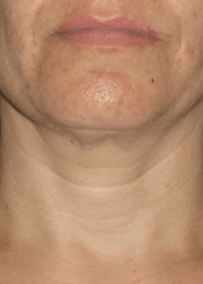 Ultherapy Before & After Patient #2187