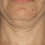 Ultherapy Before & After Patient #2187