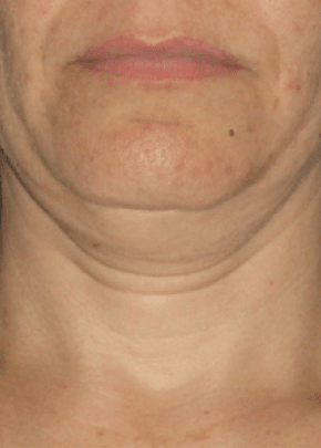 Ultherapy Before & After Patient #2187