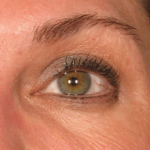 Ultherapy Before & After Patient #2186