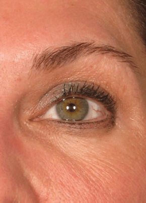 Ultherapy Before & After Patient #2186