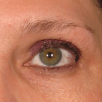 Ultherapy Before & After Patient #2186
