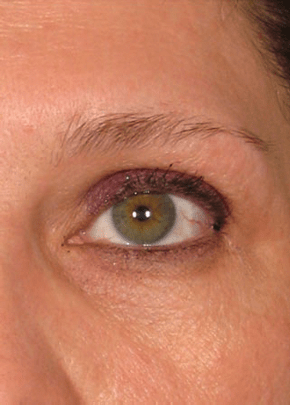 Ultherapy Before & After Patient #2186