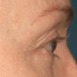 Ultherapy Before & After Patient #2185