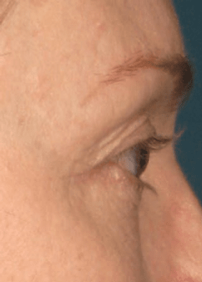Ultherapy Before & After Patient #2185