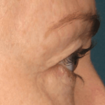 Ultherapy Before & After Patient #2185