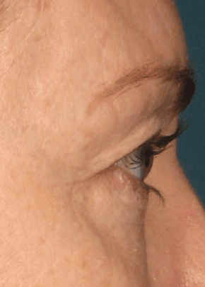 Ultherapy Before & After Patient #2185
