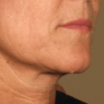 Ultherapy Before & After Patient #2184