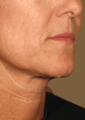 Ultherapy Before & After Patient #2184
