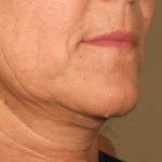 Ultherapy Before & After Patient #2184