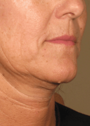 Ultherapy Before & After Patient #2184