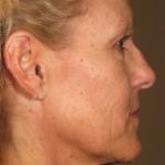Ultherapy Before & After Patient #2182