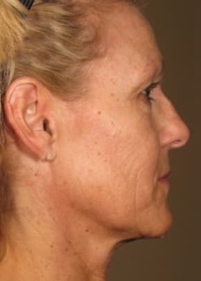 Ultherapy Before & After Patient #2182