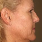 Ultherapy Before & After Patient #2182