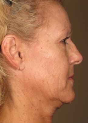 Ultherapy Before & After Patient #2182