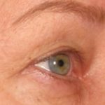 Ultherapy Before & After Patient #2181