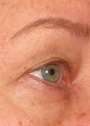 Ultherapy Before & After Patient #2181