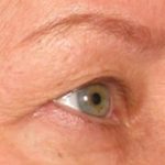 Ultherapy Before & After Patient #2181