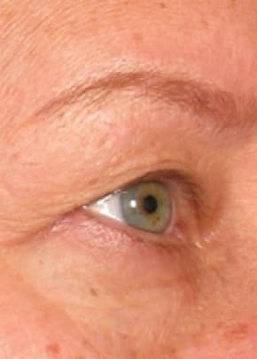 Ultherapy Before & After Patient #2181