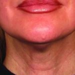 Ultherapy Before & After Patient #2180