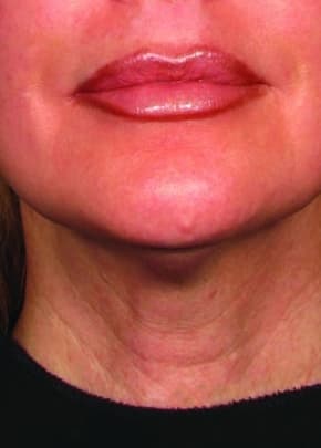 Ultherapy Before & After Patient #2180