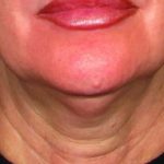 Ultherapy Before & After Patient #2180