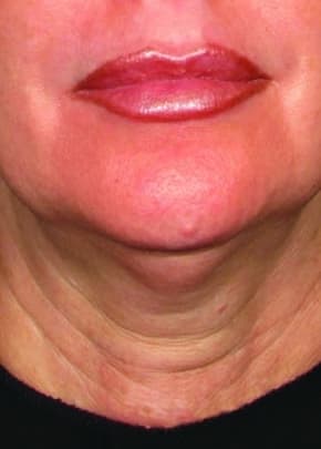 Ultherapy Before & After Patient #2180
