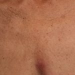 Ultherapy Before & After Patient #2179