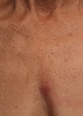 Ultherapy Before & After Patient #2179