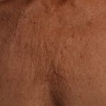 Ultherapy Before & After Patient #2179