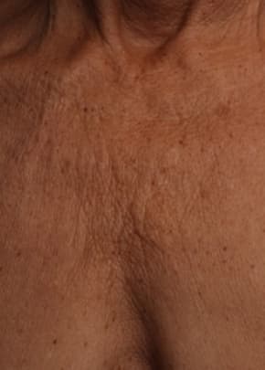 Ultherapy Before & After Patient #2179
