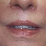Lip Lift Before & After Patient #3657