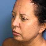 Cheeklift Threadlift Before & After Patient #4048