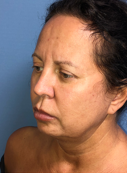 Cheeklift Threadlift Before & After Patient #4048