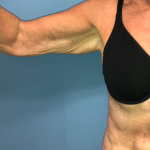 Arm Lift Before & After Patient #4047