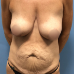 Tummy Tuck Before & After Patient #4046