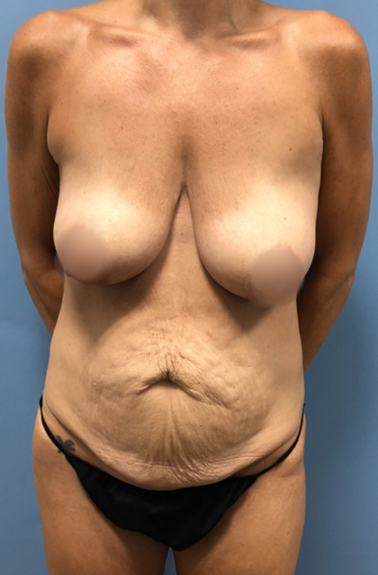 Tummy Tuck Before & After Patient #4046
