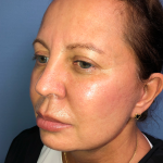 Cheeklift Threadlift Before & After Patient #4048