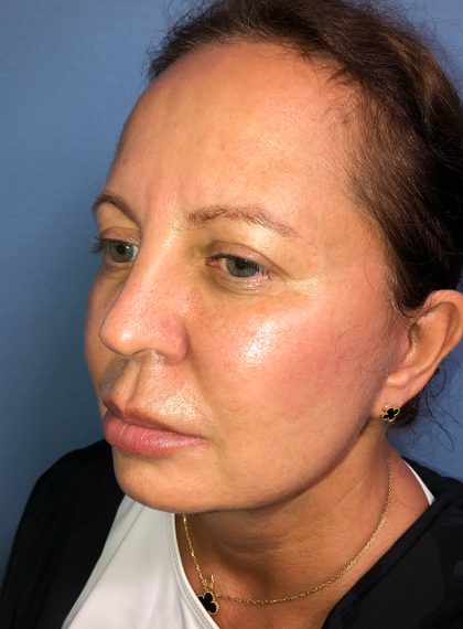 Cheeklift Threadlift Before & After Patient #4048
