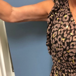 Arm Lift Before & After Patient #4047